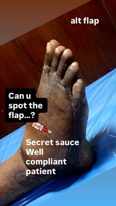 ALT flap reconstruction