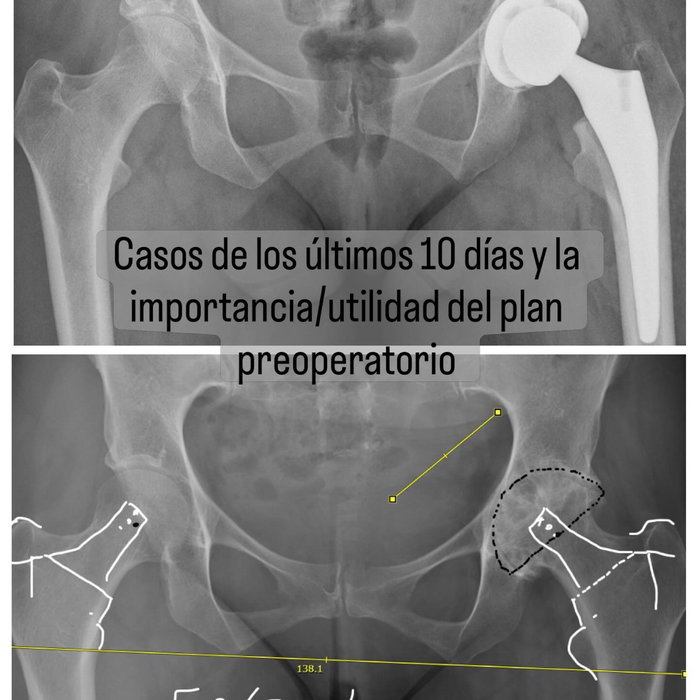 P L A N I F I C A R !!
Siempre. Es parte esencial de la cirugía y a mi parecer nos hace más “sencillo” y predecible algo