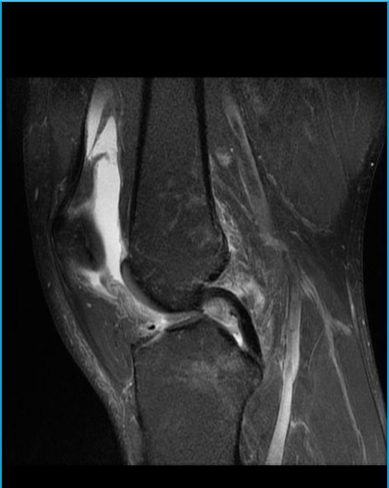 Whelp… I got my answer, Full ACL and meniscus tear. 

If you need me I’ll be throwing myself a pity…