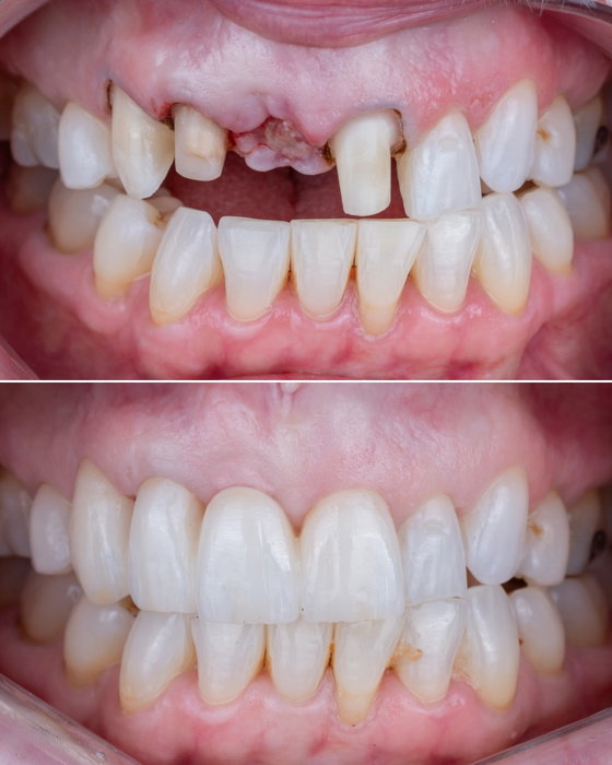 Failing tooth 🦷
The patient presented with a failing that had been previously