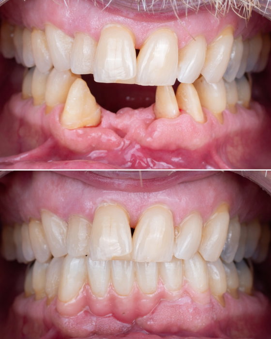 Failing lower teeth with extensive bone loss and mobility, restored with a zirco