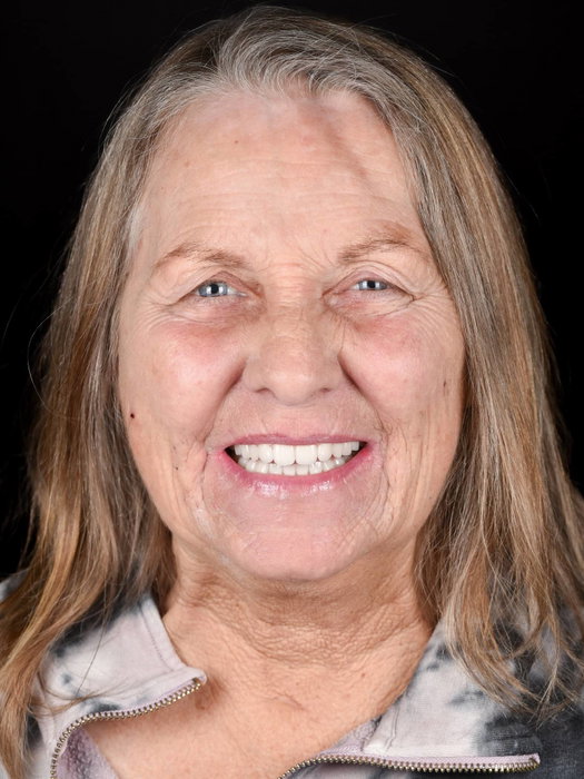 From discomfort to confidence
Our patient came to us with mobile teeth, signifi