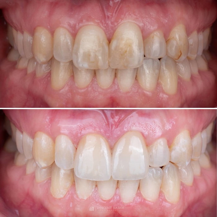 This patient came to us with discolored front teeth and aging composite restorat