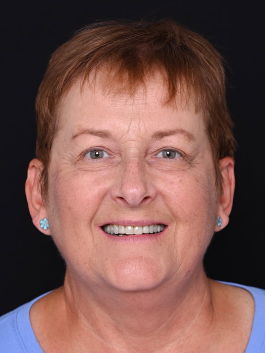 Our lovely patient came to us unhappy with the appearance of her front teeth and