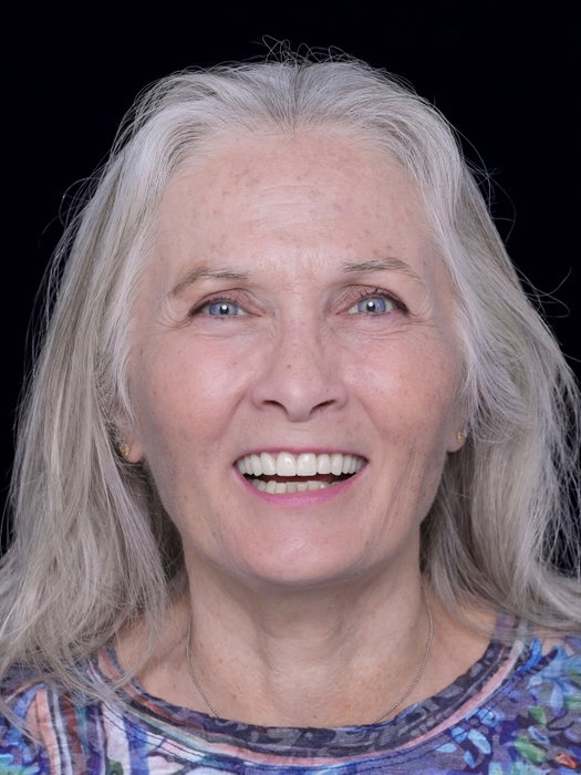 Years of extensive dental work, including multiple fillings, failing crowns, and