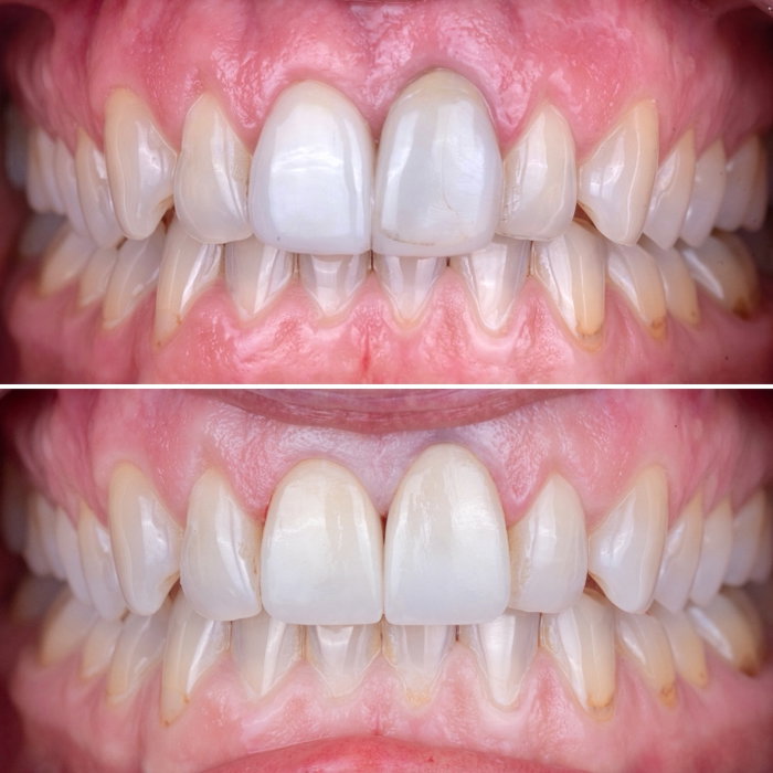 Color off. Shape off. Harmony missing. ❌
New restorations. Perfect blend. Balanc