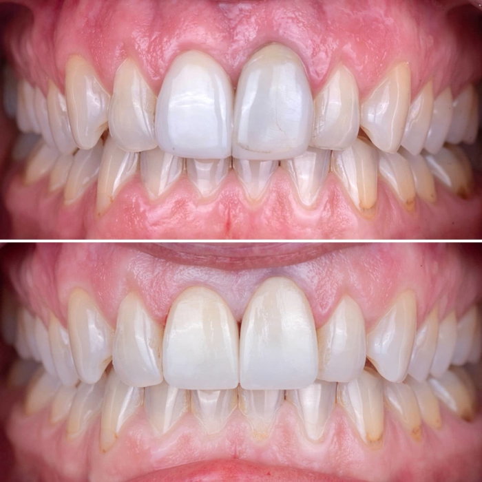 Color off. Shape off. Harmony missing. ❌
New restorations. Perfect blend. Balanc