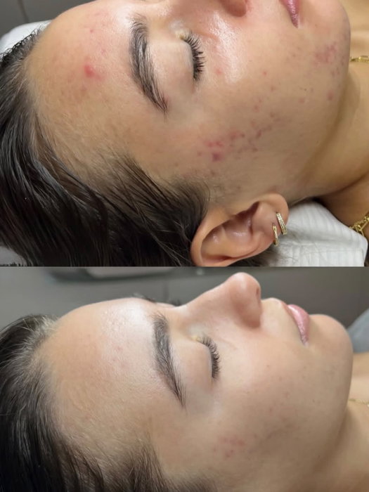 The Stem Cell Facial by Diana ✨

A two-step chemical peel that helps improve the...