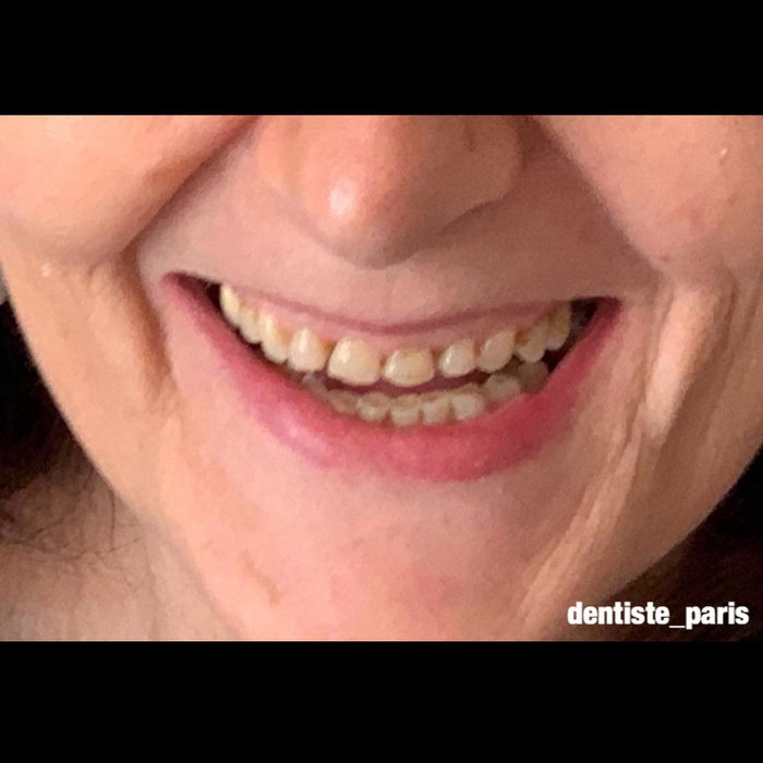 Sourire naturel suite à une réhabilitation complète implantaire (image 2 sur 3)