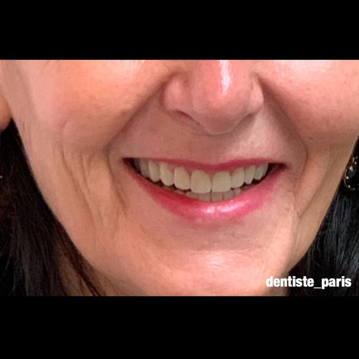 Sourire naturel suite à une réhabilitation complète implantaire (image 3 sur 3)