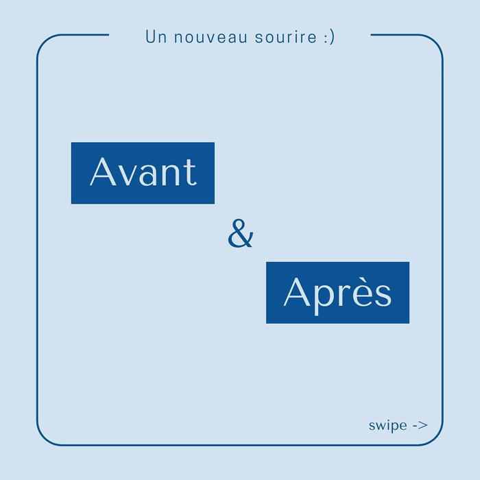 Sourire naturel suite à une réhabilitation complète implantaire (image 1 sur 3)