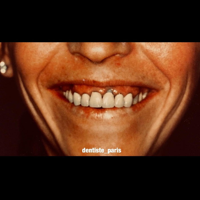 Première publication, premier avant/après. Chirurgie des gencives + remplacement anciennes couronnes . Il avait 25 ans quand il a fait ça 🏻 (image 2 sur 3)