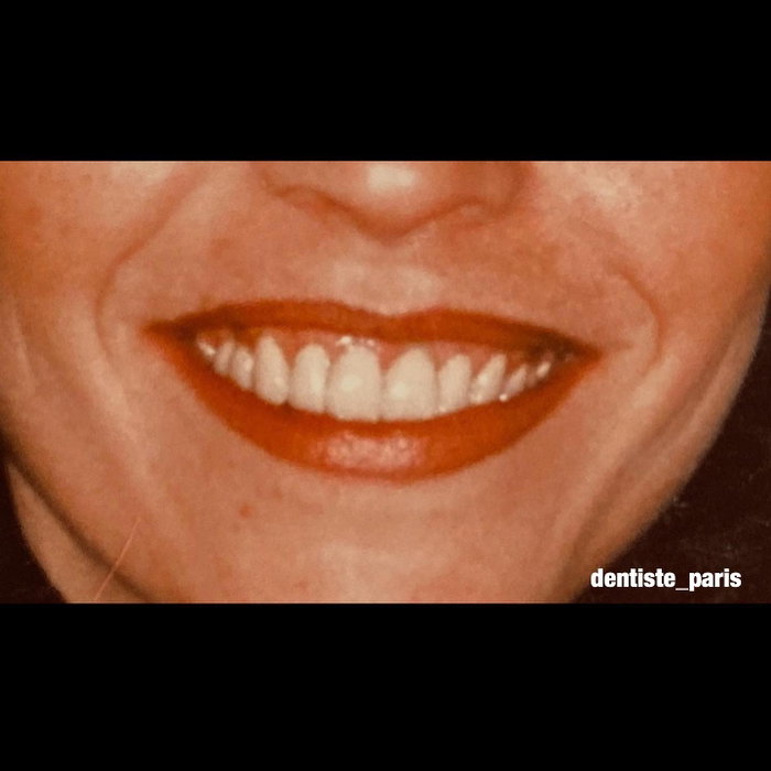 Première publication, premier avant/après. Chirurgie des gencives + remplacement anciennes couronnes . Il avait 25 ans quand il a fait ça 🏻 (image 3 sur 3)