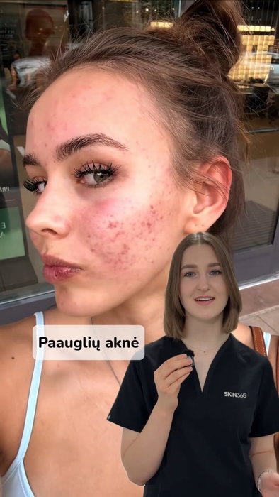 Paauglio vonios lentynoje daugėja priemonių, o spuogų nemažėja? 🫧
Aknės priežiū