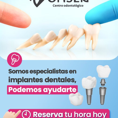 🦷✨ ¿Te faltan dientes y quieres una solución fija y segura? En Clínica Onsen somos especialistas en implantes dentales. Recupera tu sonrisa, tu seguridad y la