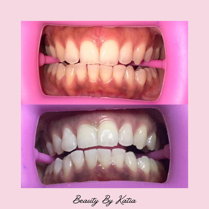 ✨ Brighten your smile ✨
1 full hour of professional teeth whitening for $85
Limited-time offer only.🤍