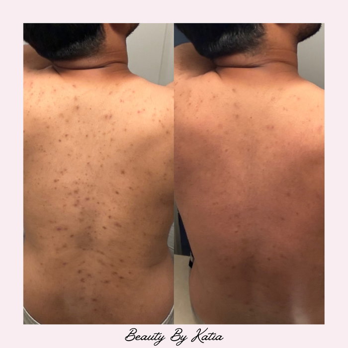 One Zena Algae Peel + Whitening Ampoule later… 🌿✨

Results like these come from years of experience, consistency & dedication to perfecting my craft. Customized treatments make all the difference. 🤌🏼💗