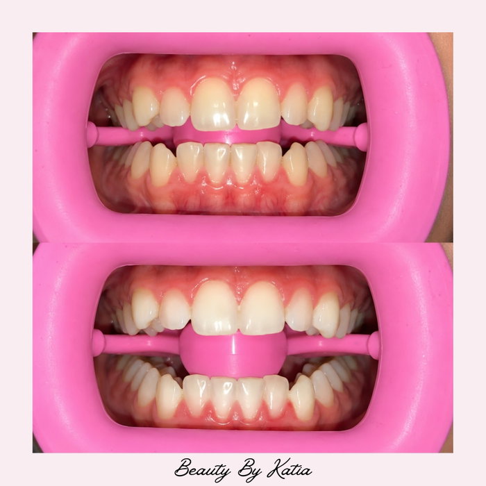 Smile upgrade activated 🦷✨ One whitening session later and WOW 😍