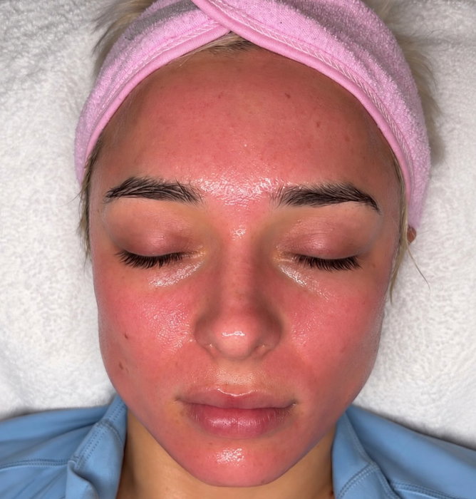 How are all my clients this beautiful?! 😩✨ There’s something sooo satisfying about a fresh microneedling session,the glow, the redness🤌🏼🩷 Skin renewal officially activated 🧬