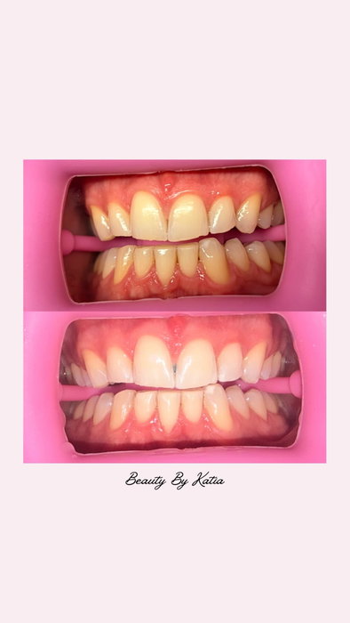 Teeth whitening training available at again! 😄💖