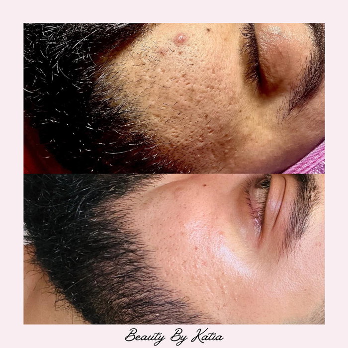 Microneedling done right ! 😍 proper treatments + medical grade skincare will help you reach your skin goals! What are your current skin concerns? Comment Below ⬇️
