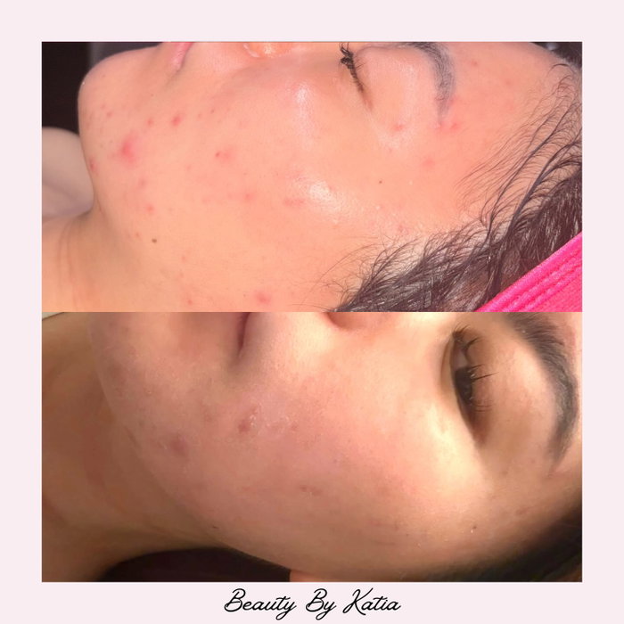 We achieved these results after 1 treatment 😍 high frequency + AHA peel. This peel is very superficial, meaning it only penetrates the epidermis. There is no downtime at all and it eliminates all acne causing bacteria while increasing cellular turnover 😍🙌