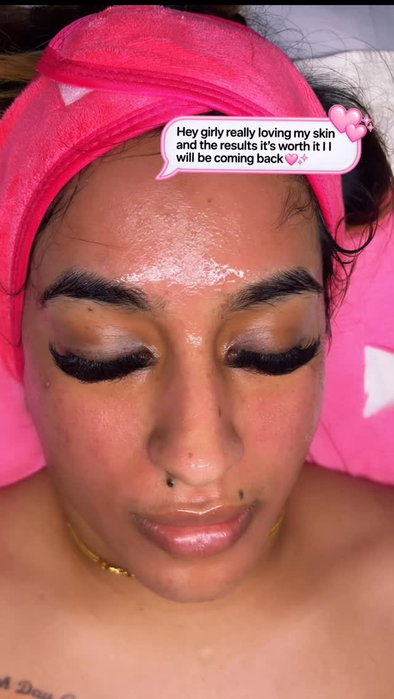 Why are all of my clients so gorgeous?! 😍💋 We did microneedling x hyaluronic acid 💧x zena brightening ampoule 💡