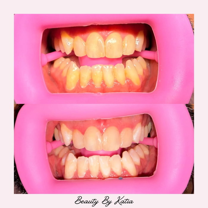 Progress over perfection. 🤍 Even after one session, the difference is already showing! Not every smile reaches its brightest shade in one visit. Stay tuned for the final results!
