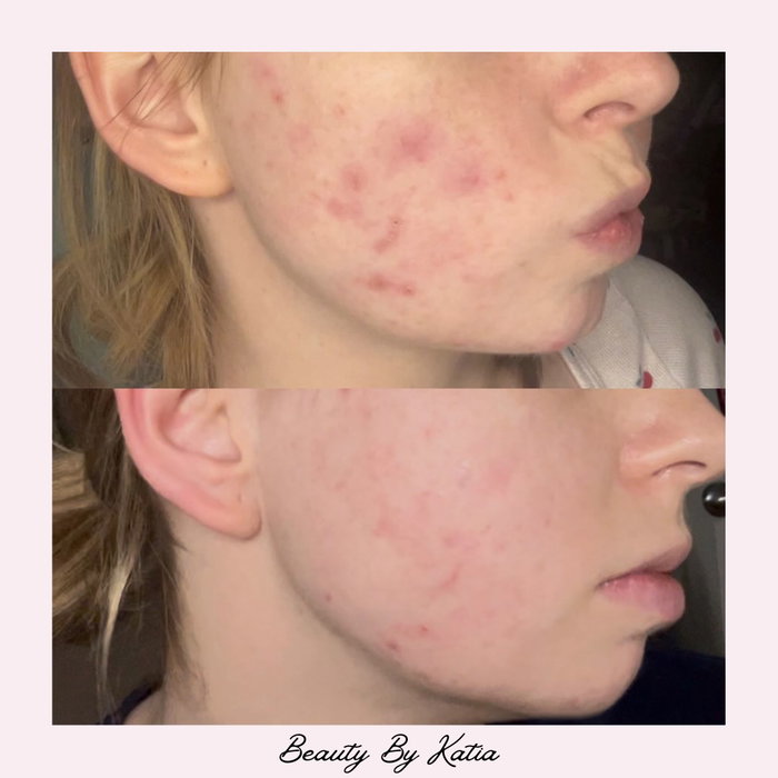 Less than a month into her skin journey and we’re already seeing amazing progress! 🫶🏼 acne treatment + medical grade skincare routine 💕