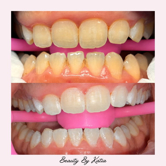 POV: You finally booked the teeth whitening appointment you’ve been putting off. ✨