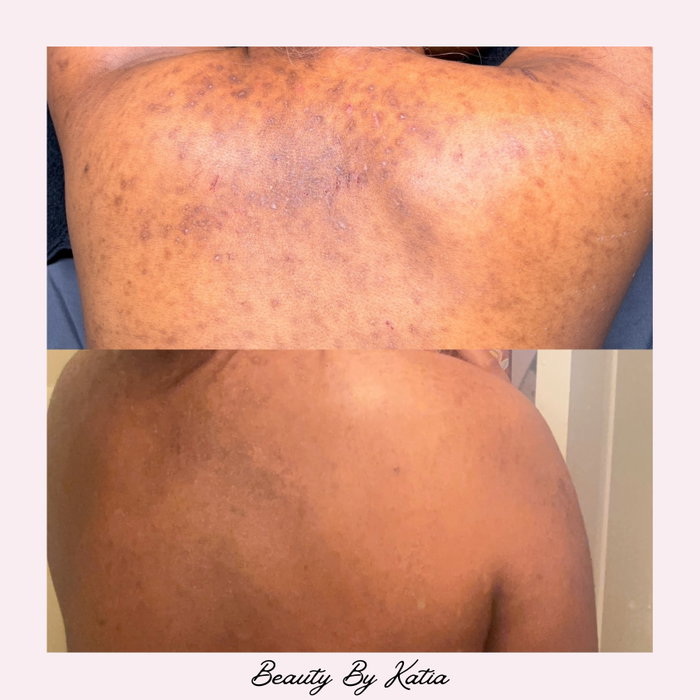 ONE treatment and look at that even skin tone 😍✨ The Zena Algae Peel does it every time. Forever one of my favourite treatments! 🌿
