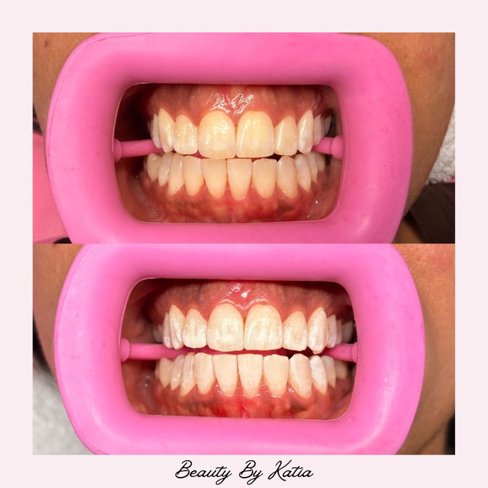 The results speak for themselves 🦷✨ Brighter, whiter & instantly refreshed after just ONE session 🤍