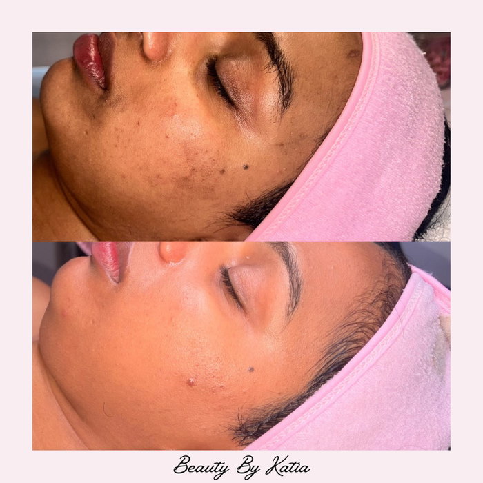 Can we just take a moment for this before & after?! 🤩 We evened out skin tone, softened texture, and brought back that healthy, natural glow. This is why consistency and the right treatments make all the difference.