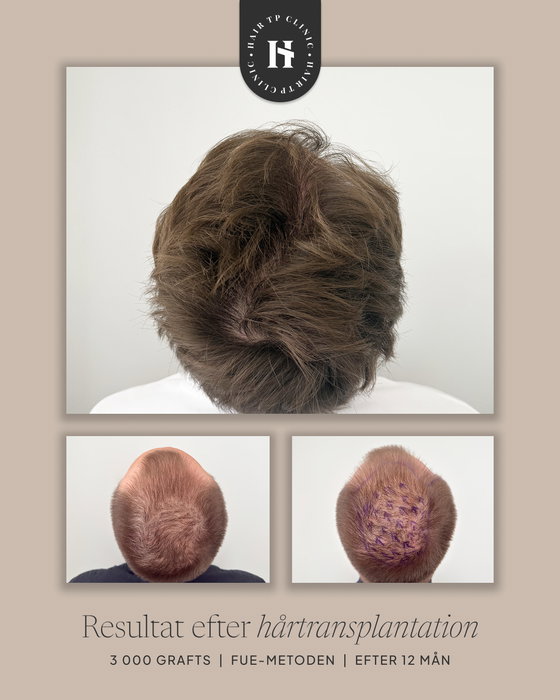 Här kan du se skillnaden före och efter en hårtransplantation!