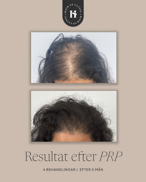 PRP-behandling är ett naturligt sätt att stimulera hårets tillväxt, med hjälp av…
