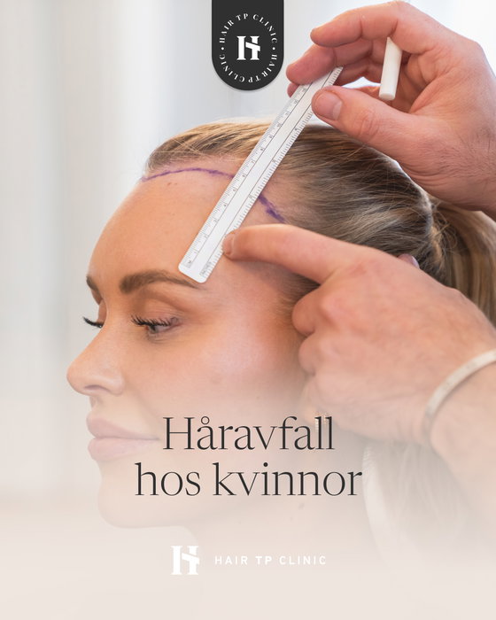 Håravfall hos kvinnor kan ha flera orsaker! Men vanligast är hormonella förändri…
