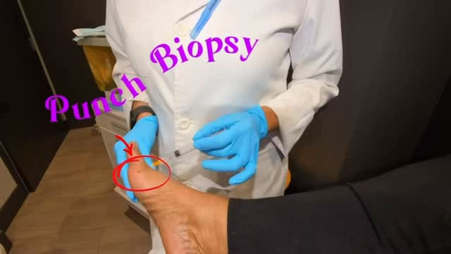 🔬 Not every skin condition tells the full story at first glance.

Watch the video to learn how a punch biopsy is performed and why it can be an important step in your care.

When a lesion, growth, discoloration, or persistent skin change requires a closer look, a punch biopsy may help provide answers. This quick in-office procedure allows a small tissue sample to be examined by a pathology laboratory, helping guide diagnosis and treatment.

✔️ Performed in-office
✔️ Minimal discomfort
✔️ Helps identify benign and malignant conditions
✔️ Supports evidence-based treatment decisions

FRANCO & CO
Physician. Surgeon. Scientist.
Elevate Your Movement.

📍 Miramar, Florida
📞 Schedule a consultation today