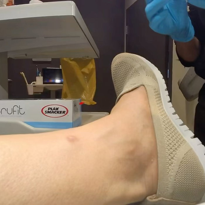 Watch this cool reel where Dr. Franco performs a punch biopsy for diagnostic purposes. Patient presented with a concerning lesion that required further evaluation to help guide treatment and ensure the best possible care. Early diagnosis matters.